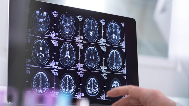 Brain scan weight loss brain impact weight gain fat anatomy hippocampus link memory fog clarity recall elasticity healthalzheimer's mental disorder depression disorders ADHD schizophrenia adult